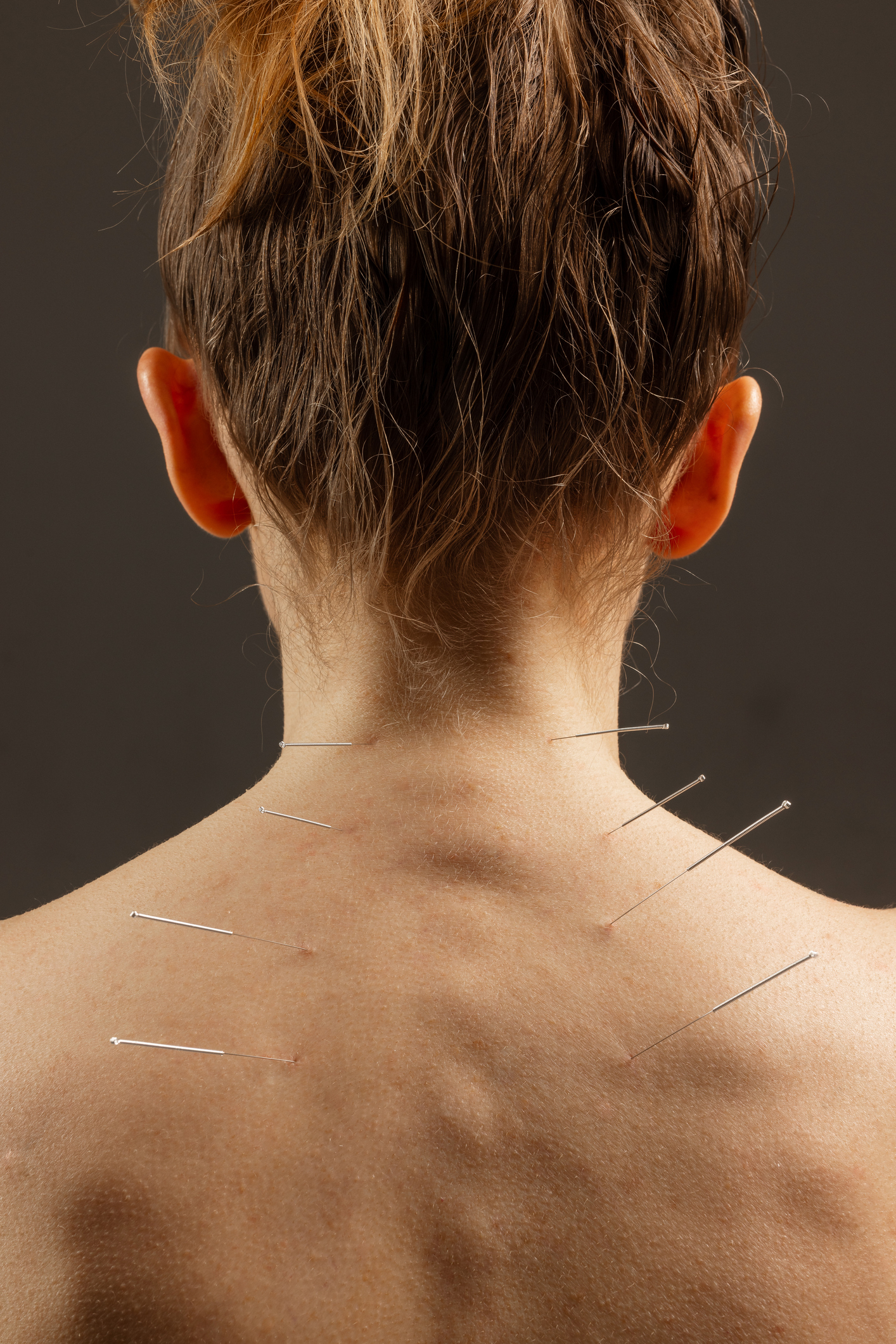 Kiné fauconnier-dry needling 